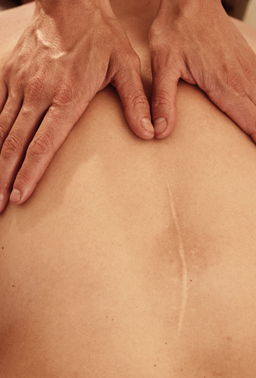 Why have Scar Massage?